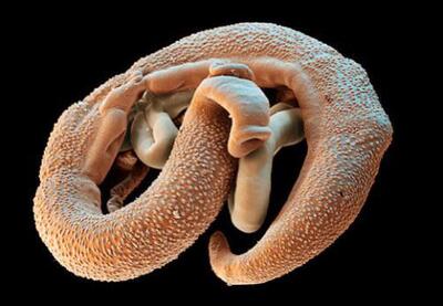 Novo tratamento promete eficácia para tratar barriga d’água